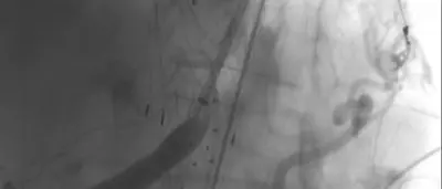 Aneurisma dell’aorta toraco-addominale, eseguito trattamento di elevata complessità dalla U.O.C. Chirurgia Vascolare del G.O.M.\n