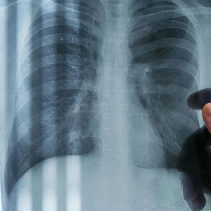 Amianto in Calabria, 600 casi di mesotelioma dal 1993: il pericolo dei 15 milioni di metri quadrati di tetti in eternit\n