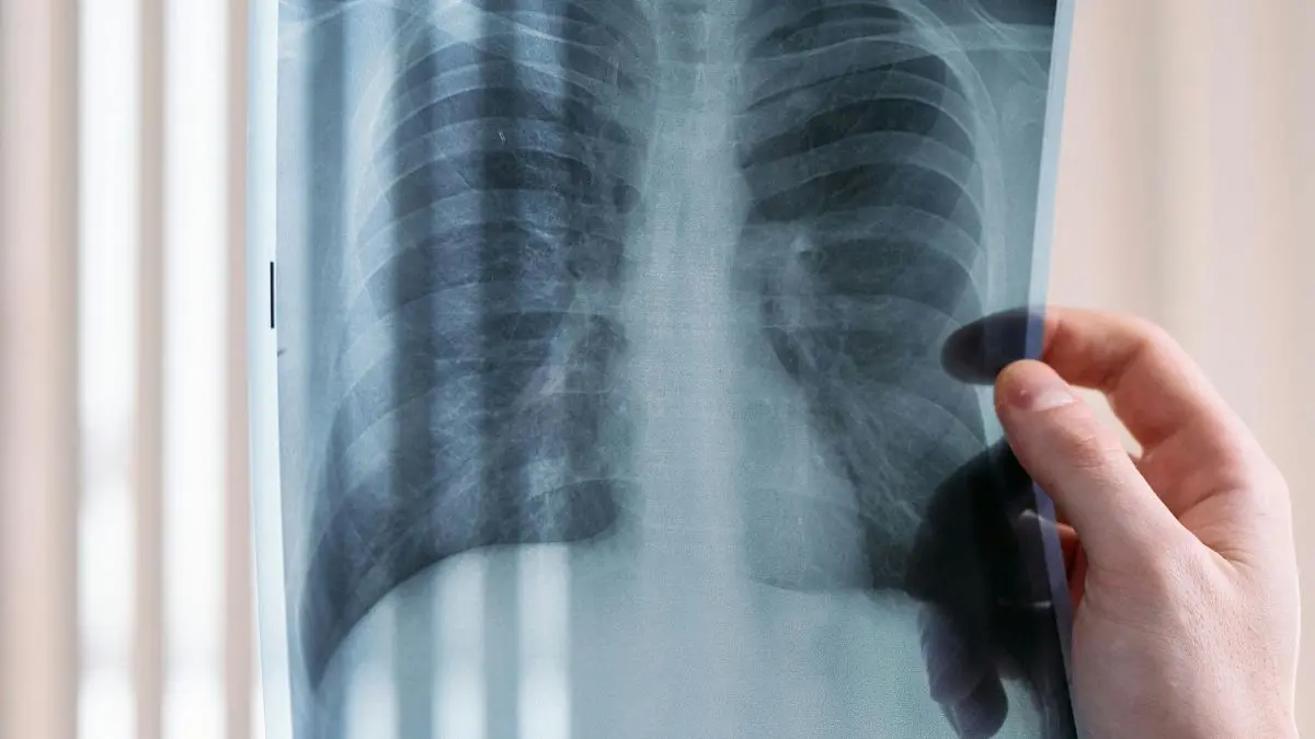 Amianto in Calabria, 600 casi di mesotelioma dal 1993: il pericolo dei 15 milioni di metri quadrati di tetti in eternit\n