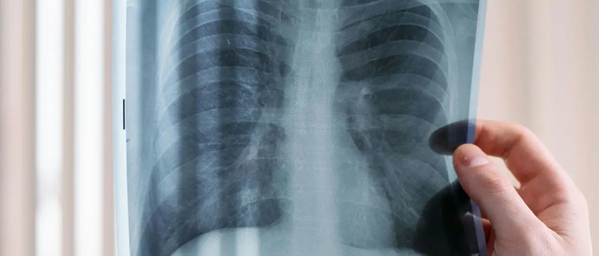 Amianto in Calabria, 600 casi di mesotelioma dal 1993: il pericolo dei 15 milioni di metri quadrati di tetti in eternit\n