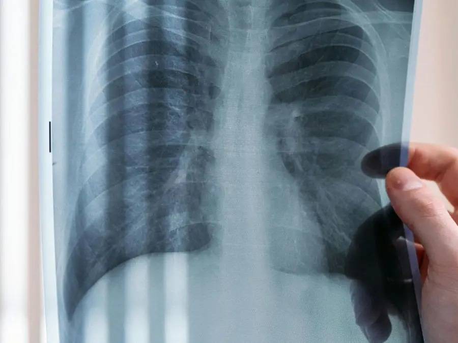 Amianto in Calabria, 600 casi di mesotelioma dal 1993: il pericolo dei 15 milioni di metri quadrati di tetti in eternit