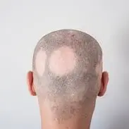 Alopecia da chemioterapia, la Regione Calabria finanzia contributi per le protesi tricologiche\n