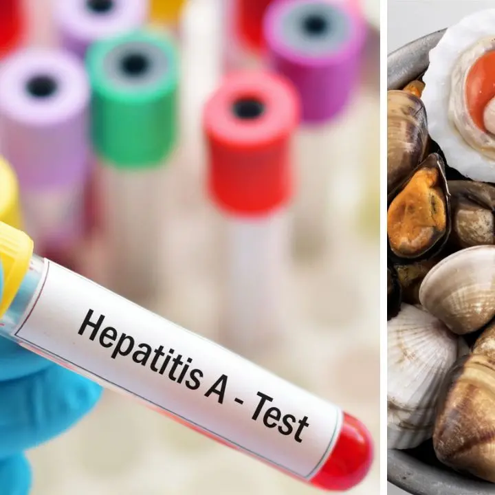 Epatite A, sei casi sotto osservazione anche a Cosenza: Annunziata in monitoraggio\n