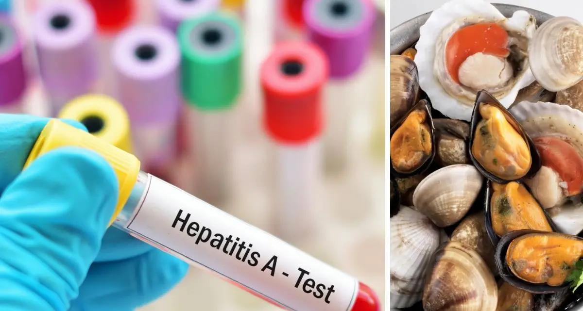 Epatite A, sei casi sotto osservazione anche a Cosenza: Annunziata in monitoraggio\n