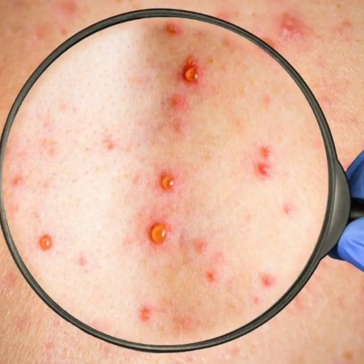 Morbillo, l’Asp di Cosenza rilancia con due giornate di vaccinazioni gratuite\n