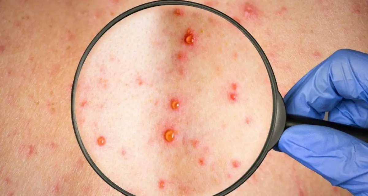 Morbillo, l’Asp di Cosenza rilancia con due giornate di vaccinazioni gratuite\n