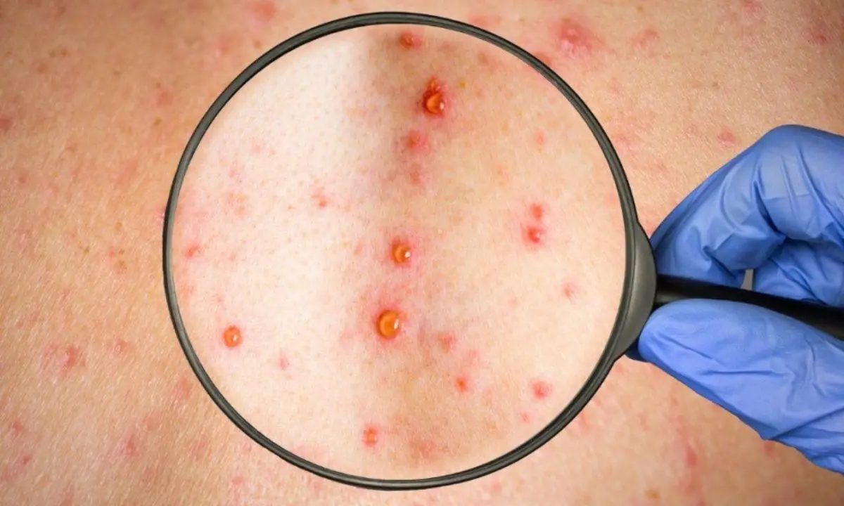 Morbillo, l’Asp di Cosenza rilancia con due giornate di vaccinazioni gratuite\n