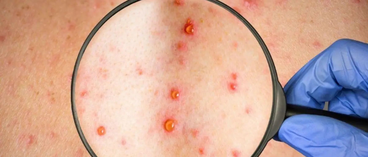 Morbillo, l’Asp di Cosenza rilancia con due giornate di vaccinazioni gratuite\n