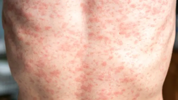 A person\\'s body is covered in a rash, measles. , Getty Images