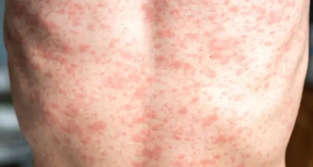 Allarme morbillo a Cosenza, cresce il numero dei contagi\n