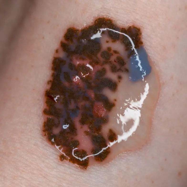Dall’Unical una possibile nuova cura contro il melanoma\n