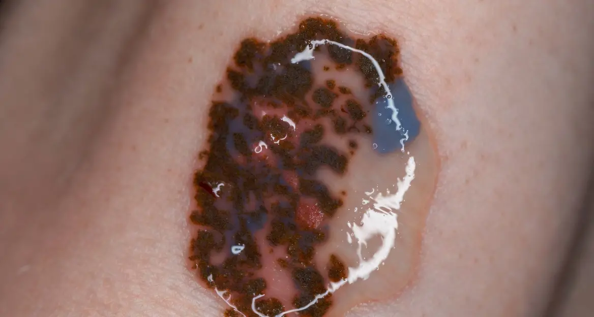 <p>Rivoluzionaria scoperta in Calabria, dall’Unical una possibile <span style=\"color:hsl(0, 75%, 60%);\">nuova cura</span> contro il melanoma</p>