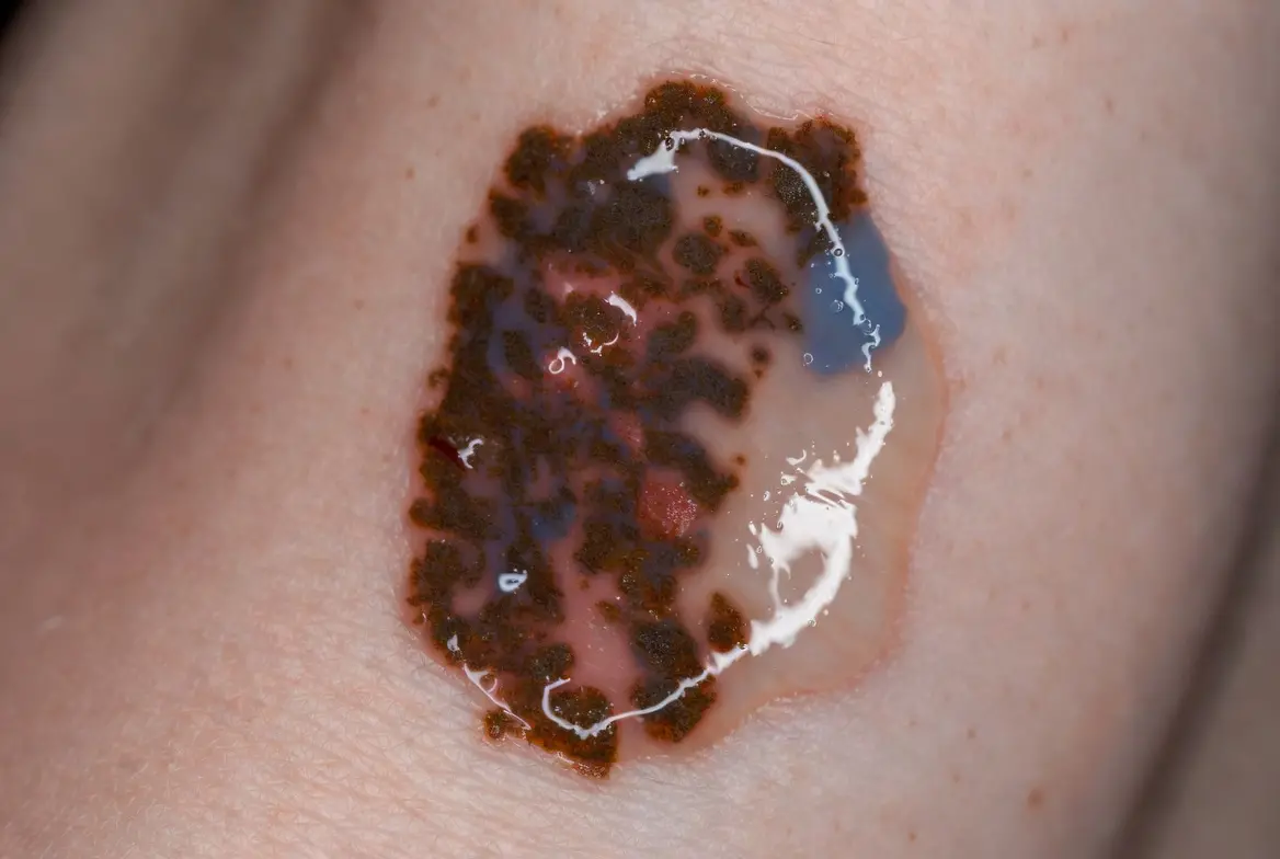 Dall’Unical una possibile nuova cura contro il melanoma\n