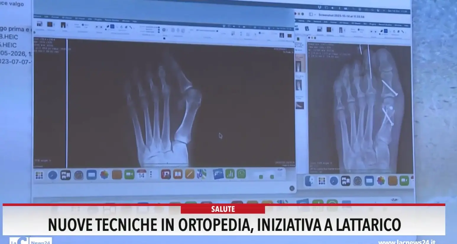 Nuove tecniche in ortopedia, iniziativa a Lattarico
