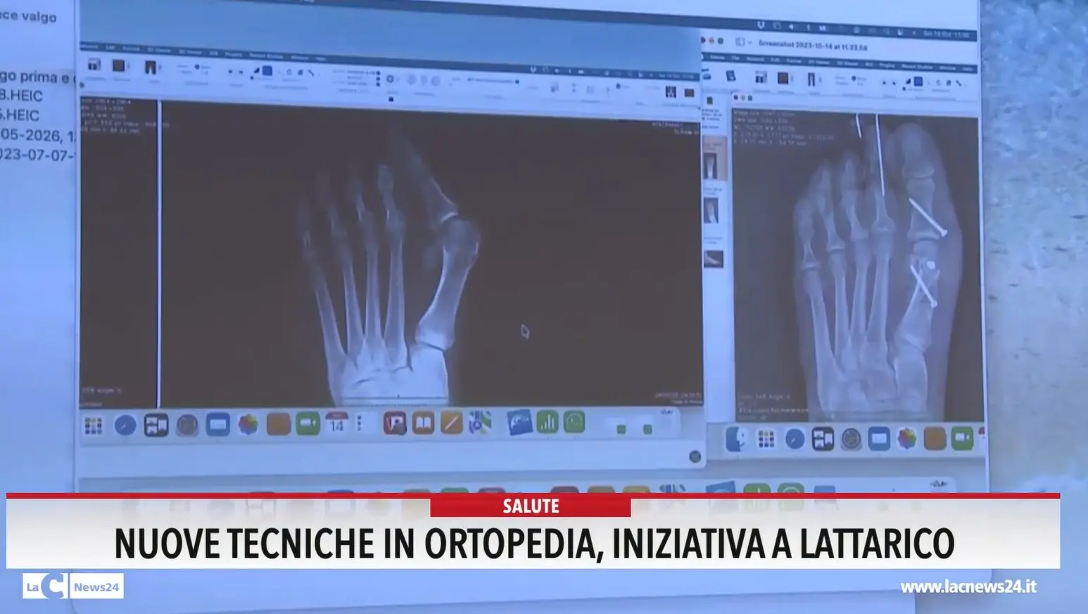 Nuove tecniche in ortopedia, iniziativa a Lattarico