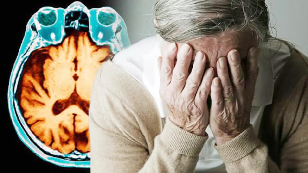 Alzheimer, svolta storica con la nuova terapia a Catanzaro: la\u00A0Dulbecco avvia\u00A0il trattamento con anticorpi\u00A0monoclonali\n