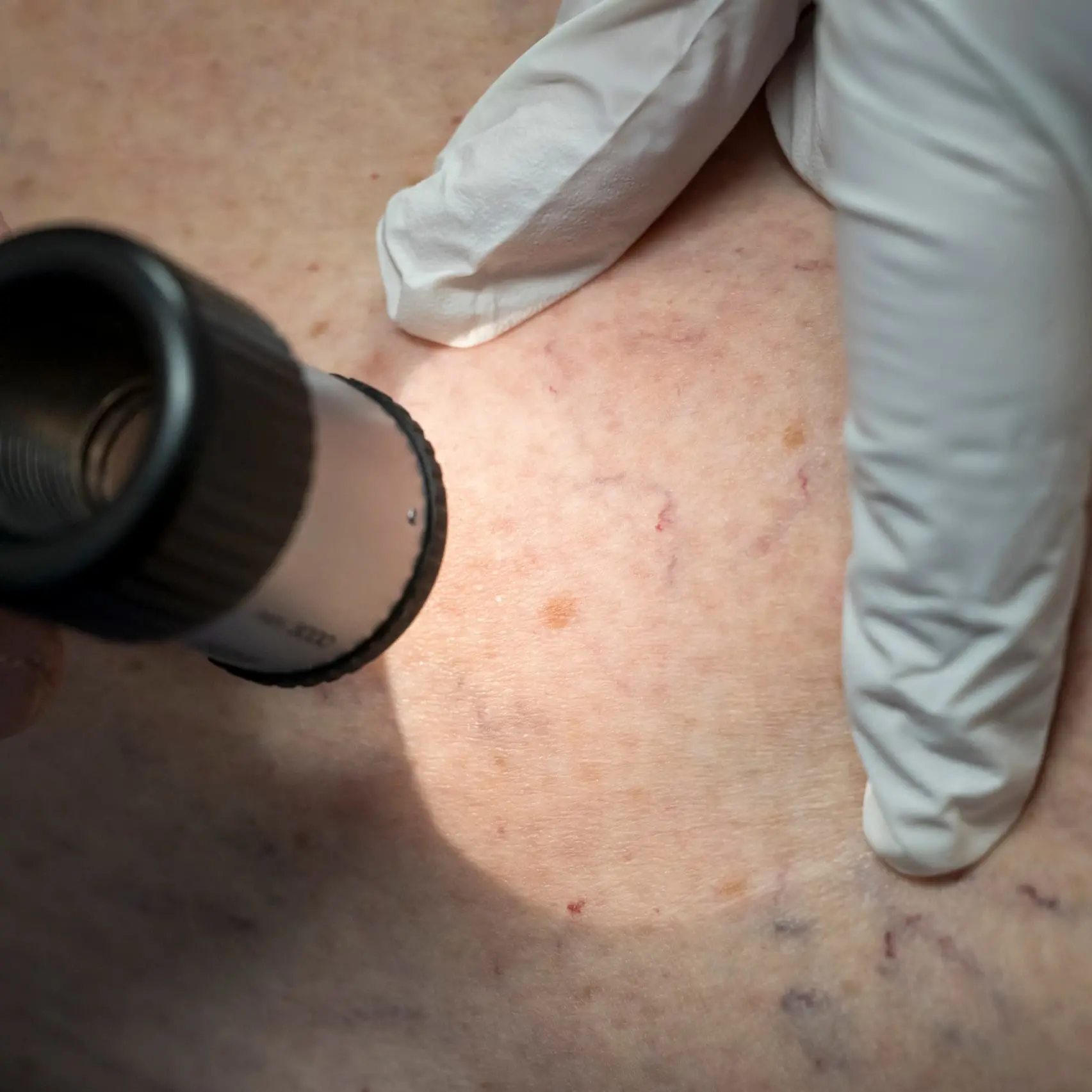 Melanoma, il vaccino personalizzato a mRNA apre una nuova speranza\n