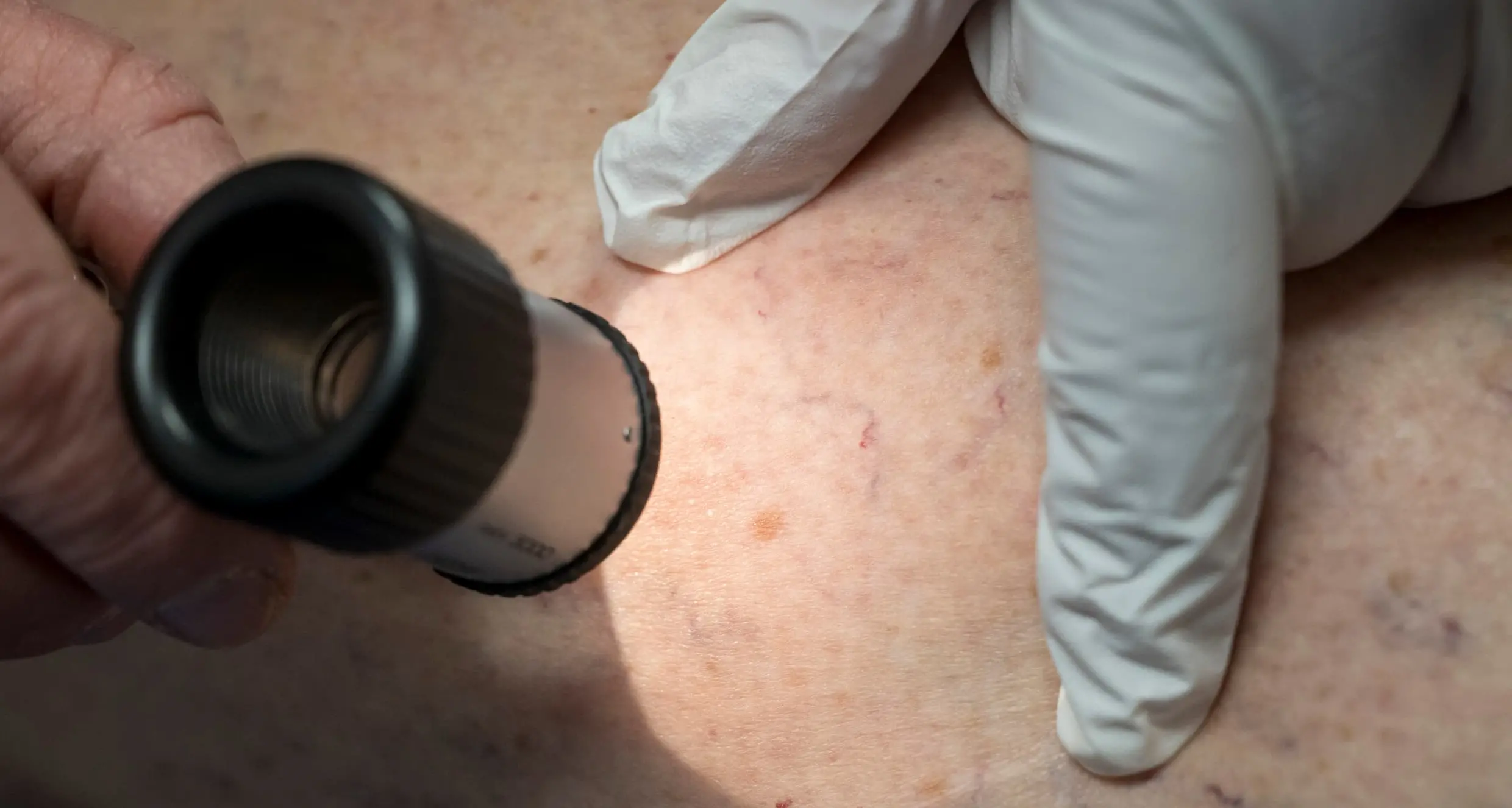 Melanoma, il vaccino personalizzato a mRNA apre una nuova speranza\n