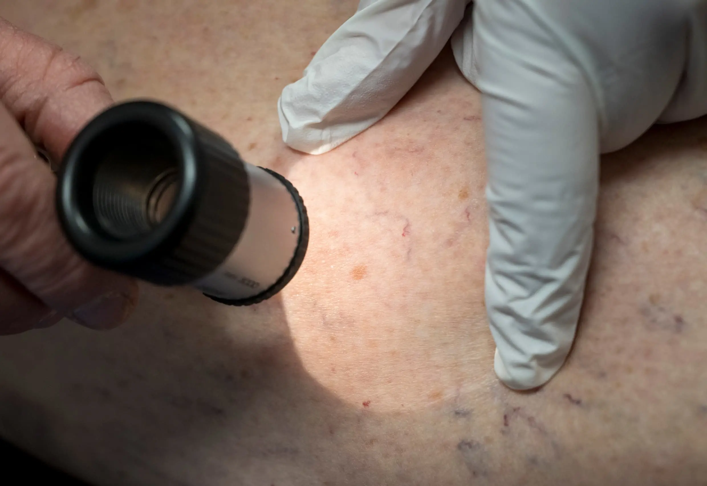 Melanoma, il vaccino personalizzato a mRNA apre una nuova speranza\n