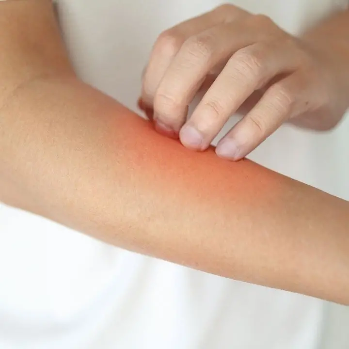 Malattia della pioggia, aumentano i casi in Europa: cos’è la dermatofilosi e come si trasmette\n