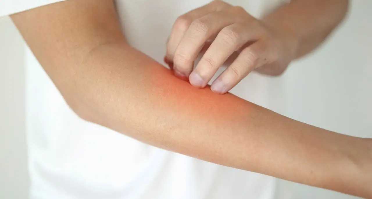 Malattia della pioggia, aumentano i casi in Europa: cos’è la dermatofilosi e come si trasmette\n
