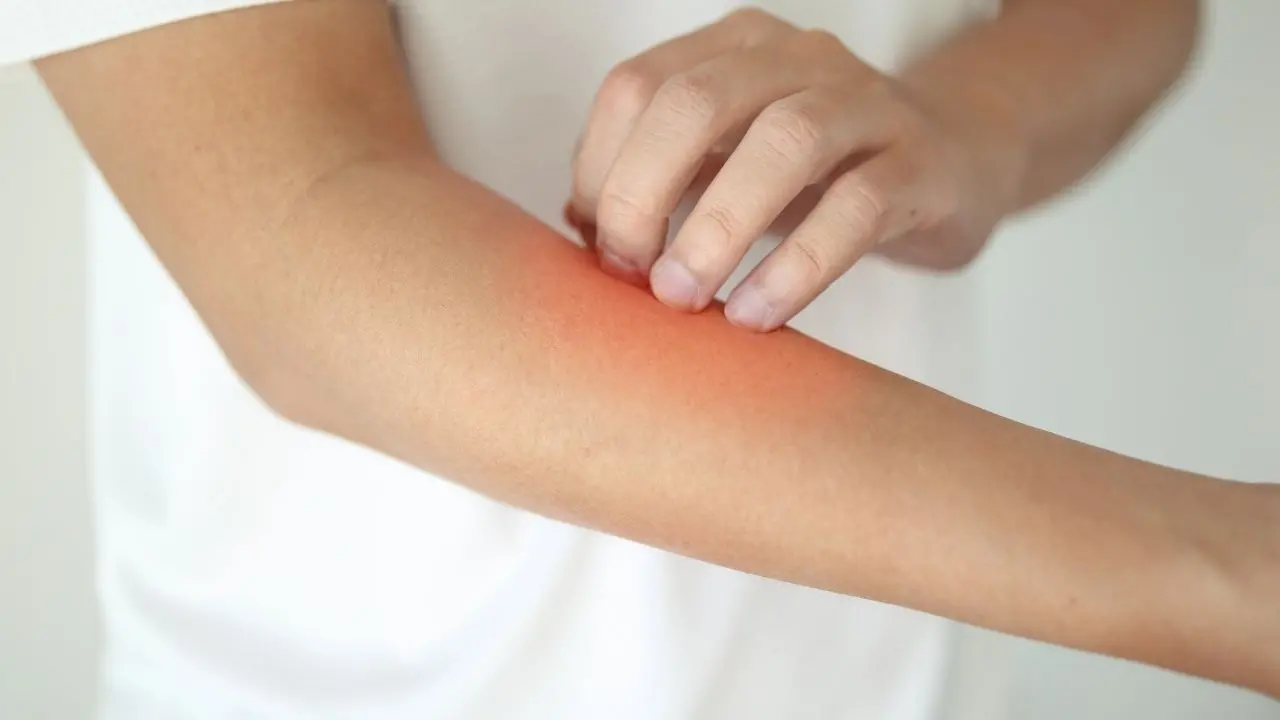 Malattia della pioggia, aumentano i casi in Europa: cos’è la dermatofilosi e come si trasmette\n