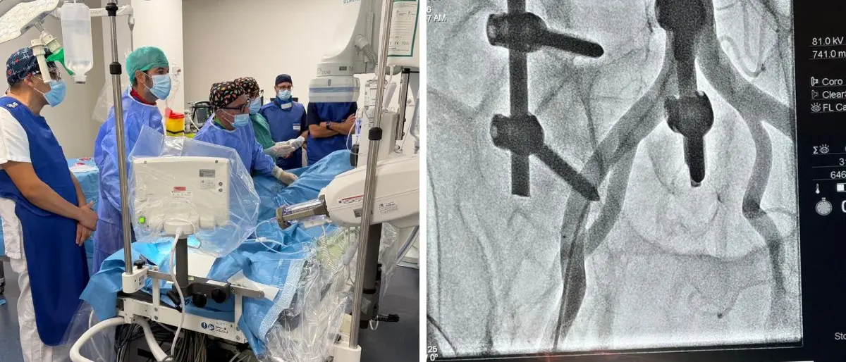 Lamezia Terme, operativa la sala di cardiologia interventistica: eseguite le prime procedure\n