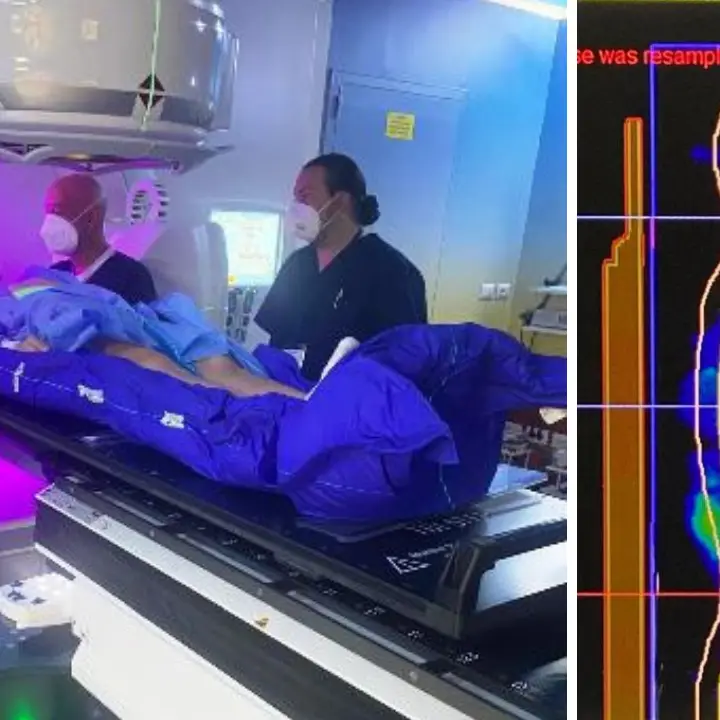 Radioterapia nei trapianti di midollo osseo: il Gom primo centro in Calabria a eseguire procedura Total Body Irradiation