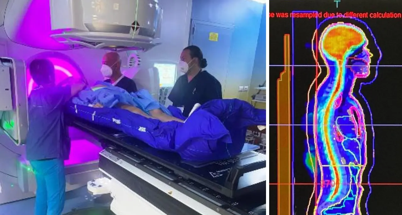 Radioterapia nei trapianti di midollo osseo: il Gom primo centro in Calabria a eseguire procedura Total Body Irradiation