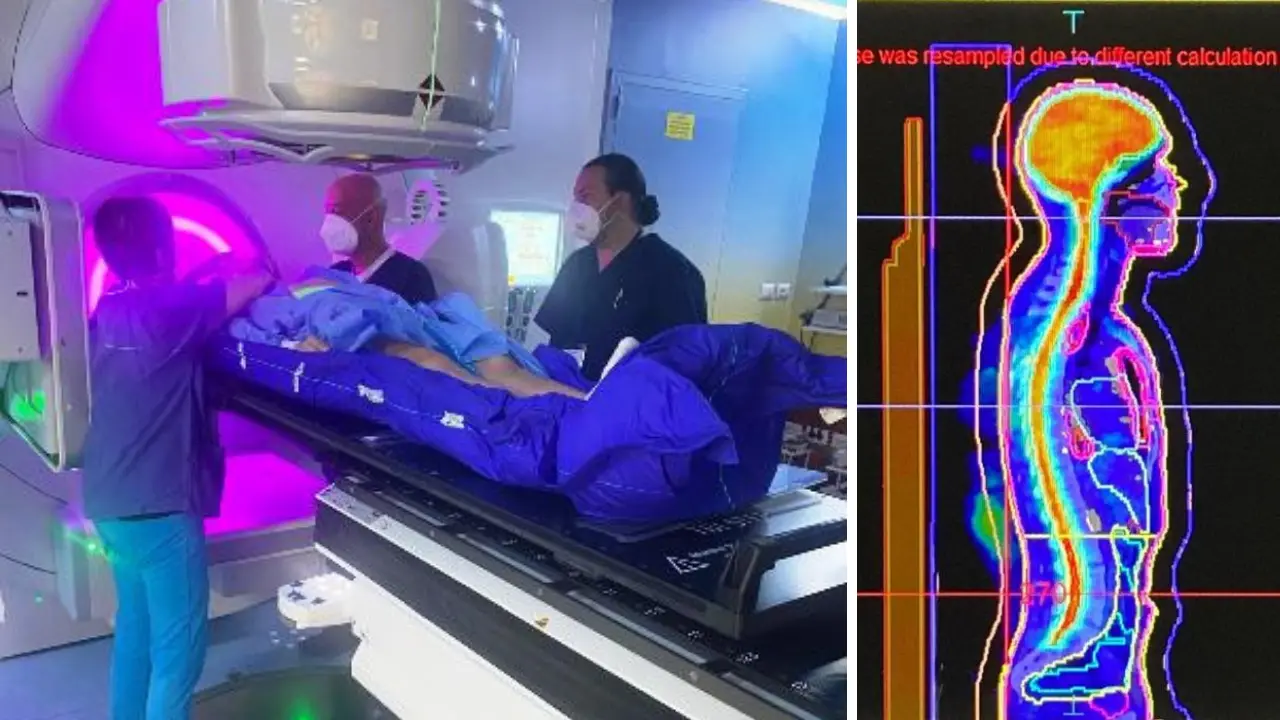 Radioterapia nei trapianti di midollo osseo: il Gom primo centro in Calabria a eseguire procedura Total Body Irradiation