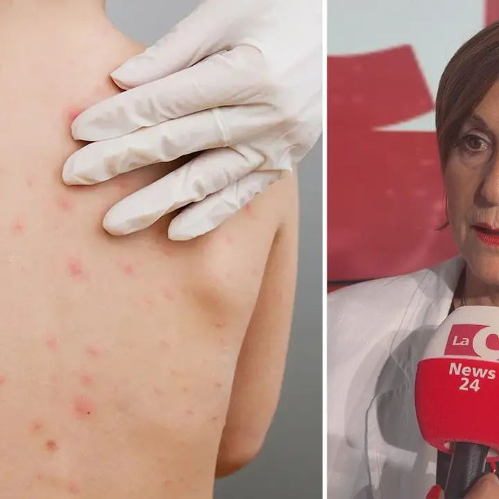 Morbillo, l'allarme della pediatra Galasso: «Non abbassiamo la guardia, vaccino\u00A0l'unica vera arma»\n
