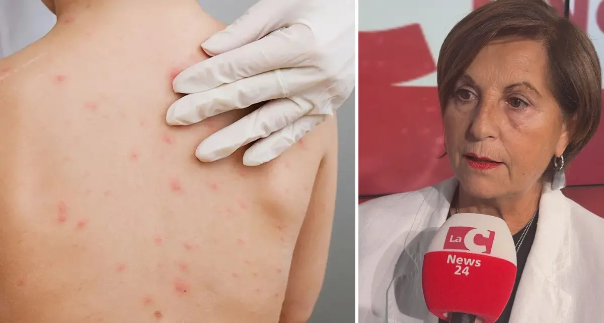 Morbillo, l'allarme della pediatra Galasso: «Non abbassiamo la guardia, vaccino\u00A0l'unica vera arma»\n